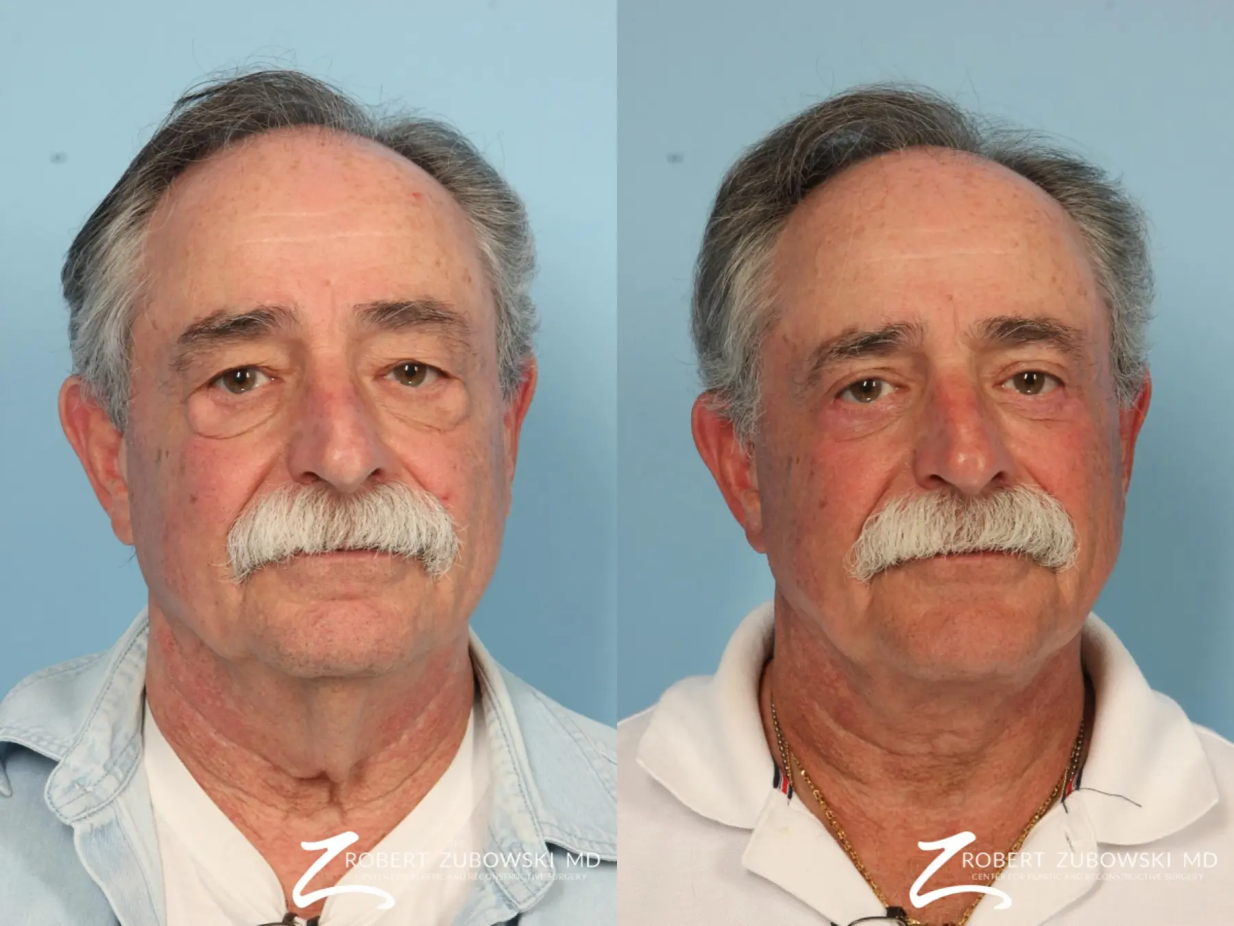 Blepharoplasty-for-men: Patient 2 - Before and After  