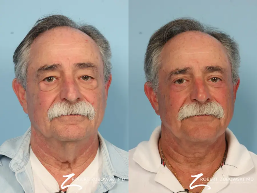 Blepharoplasty For Men: Patient 2 - Before and After 1