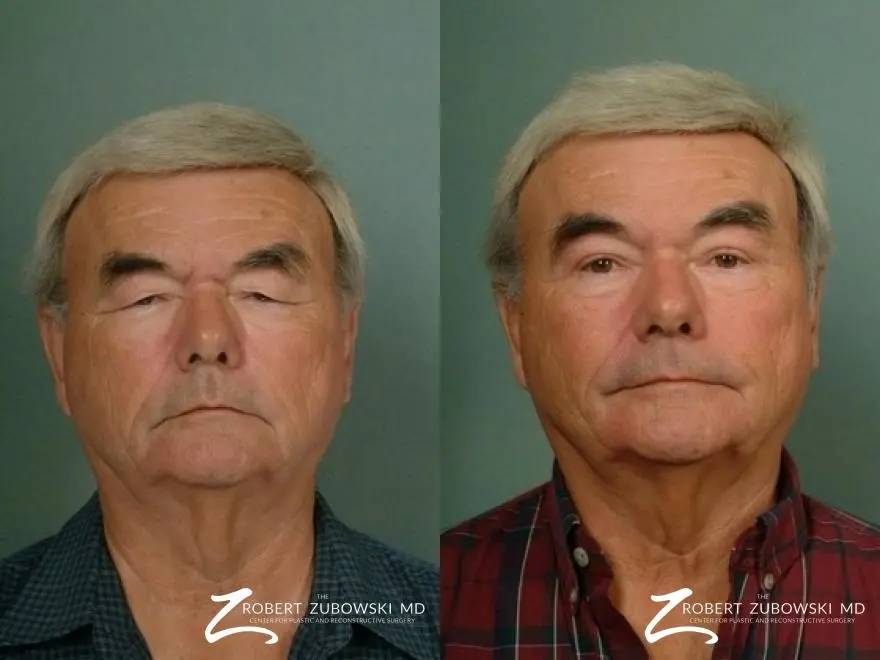 Blepharoplasty-for-men: Patient 1 - Before and After  