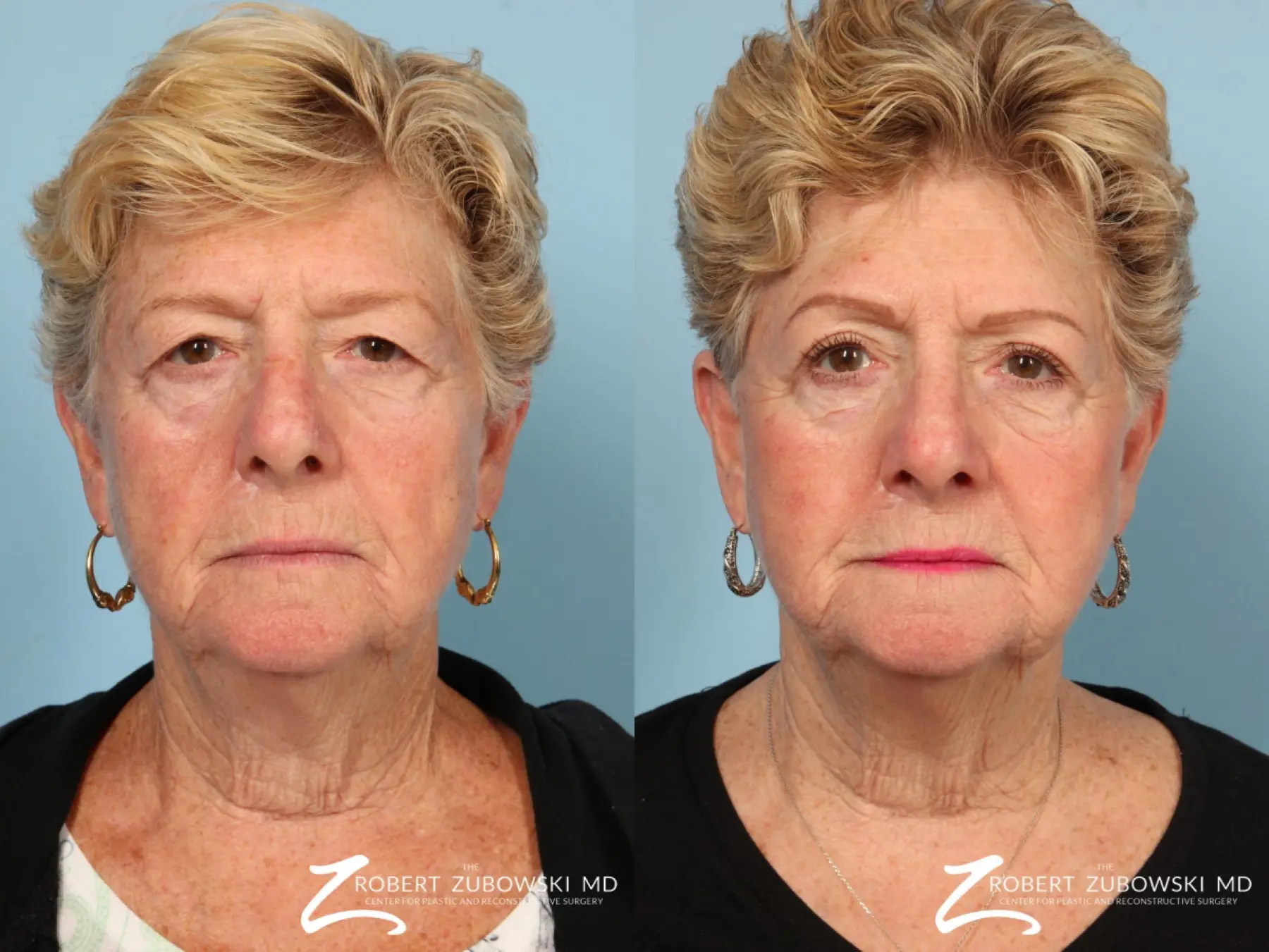 Blepharoplasty: Patient 25 - Before and After 1