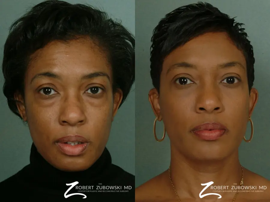 Blepharoplasty: Patient 8 - Before and After 1