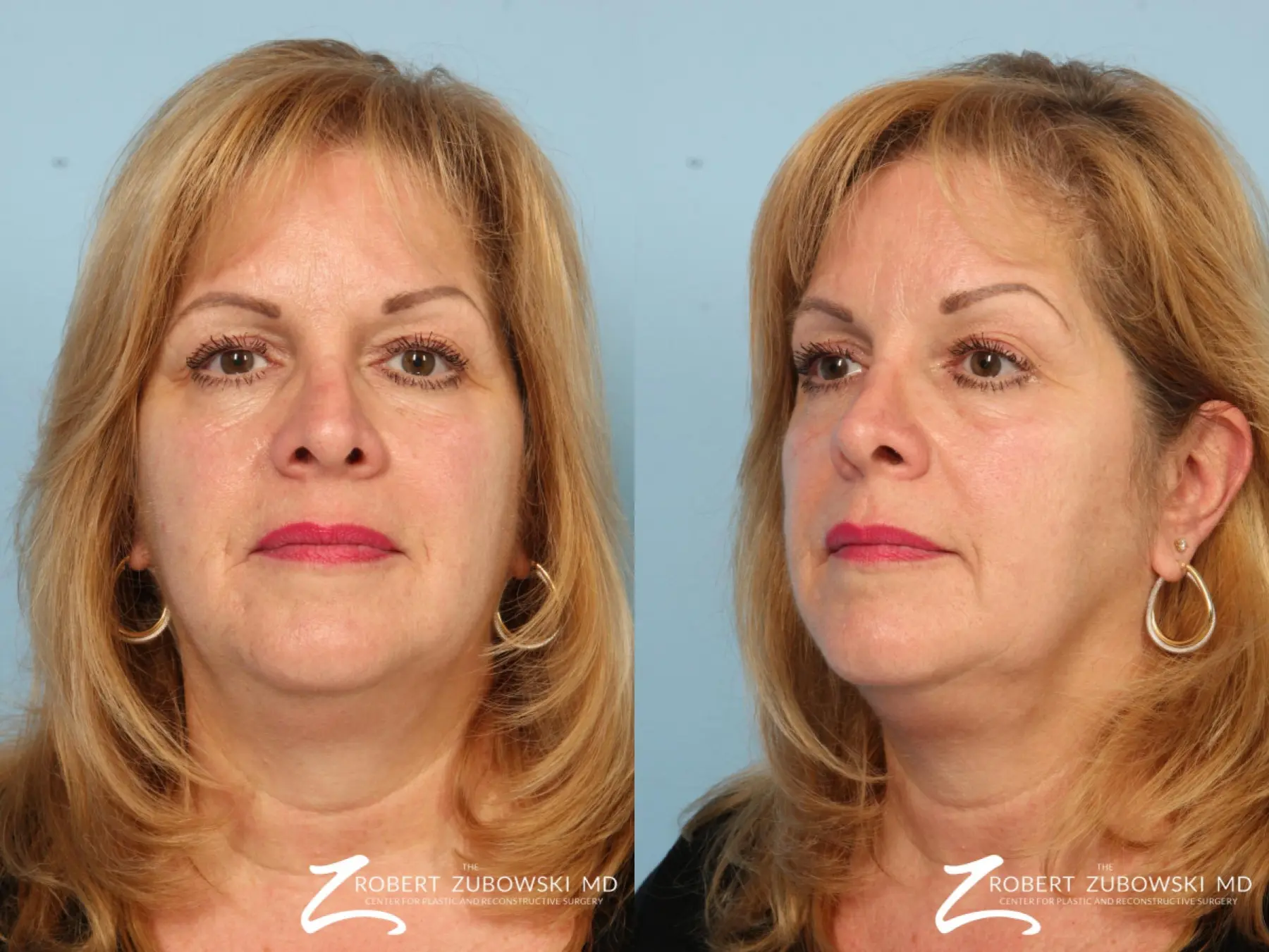 Blepharoplasty: Patient 28 - Before and After 1