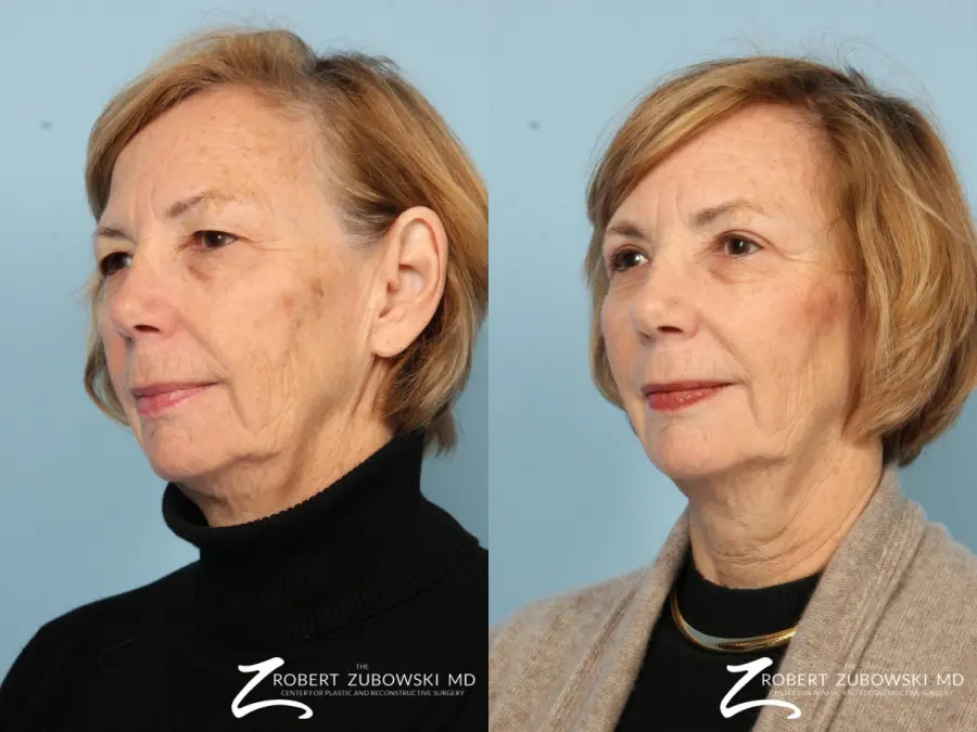 Blepharoplasty: Patient 24 - Before and After 2