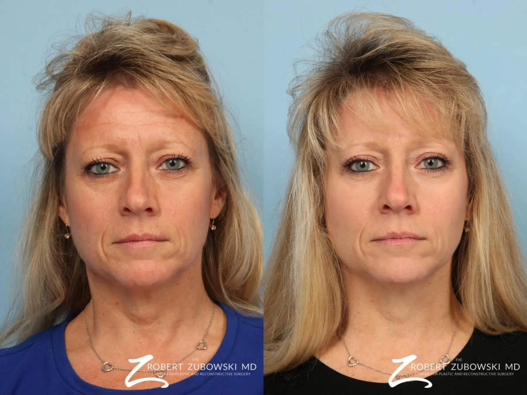 Blepharoplasty: Patient 5 - Before and After  