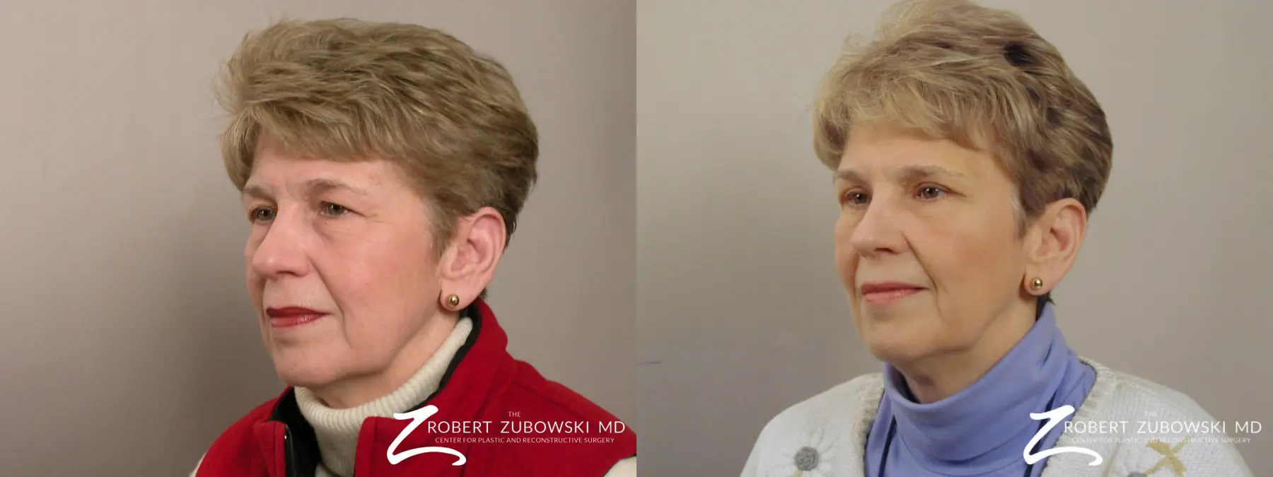 Blepharoplasty: Patient 36 - Before and After 2