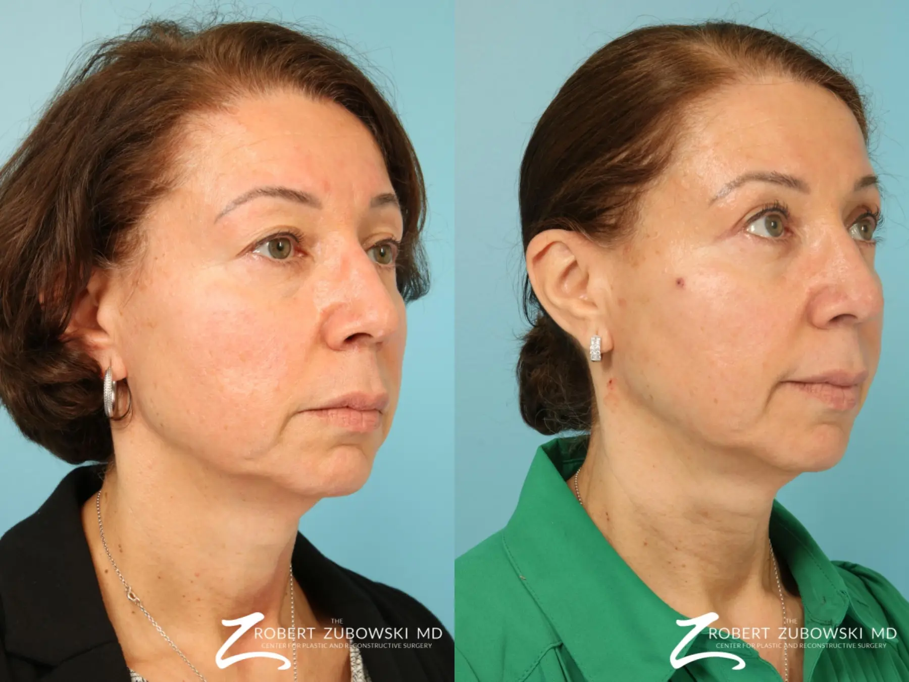 Blepharoplasty: Patient 31 - Before and After 3