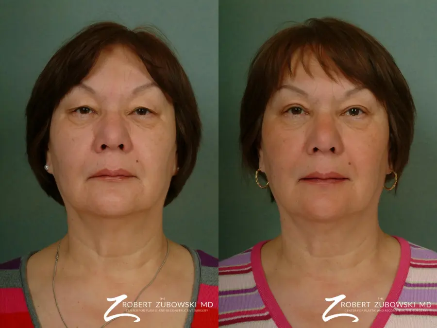 Blepharoplasty: Patient 9 - Before and After 1