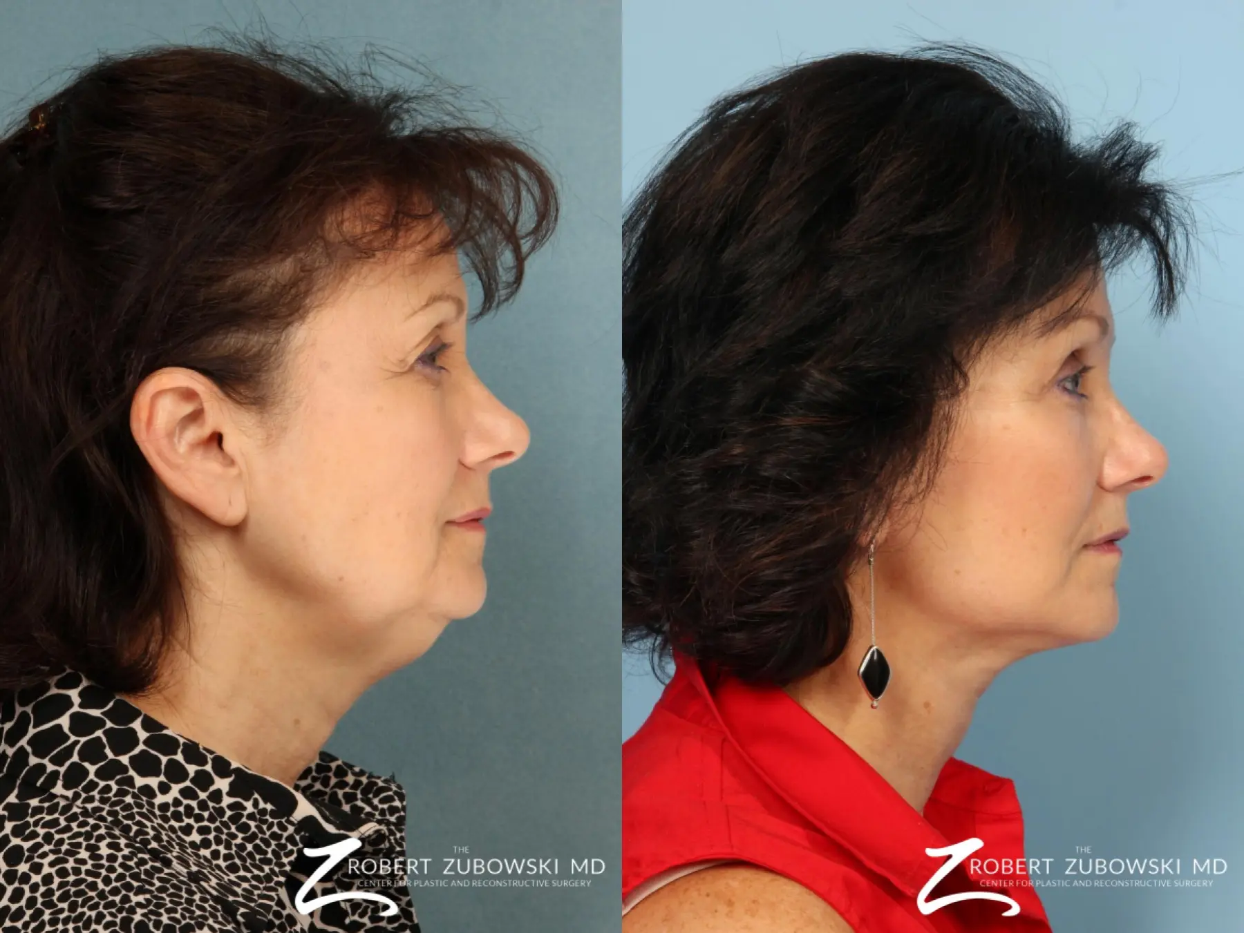Blepharoplasty: Patient 4 - Before and After 2