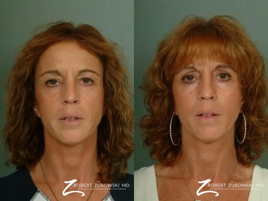 Blepharoplasty: Patient 7 - Before and After 1
