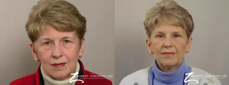 Blepharoplasty: Patient 19 - Before and After 1