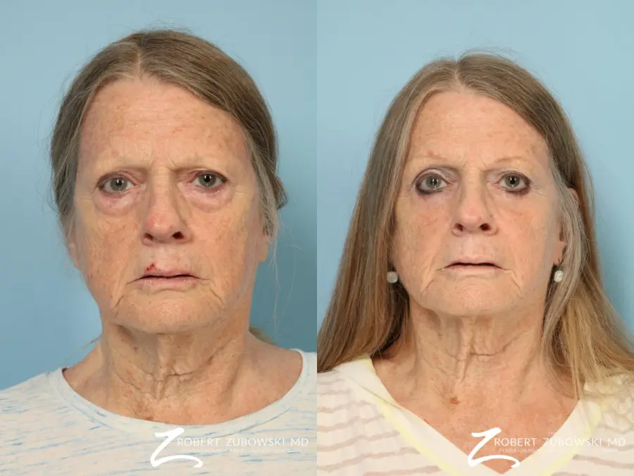 Blepharoplasty: Patient 33 - Before and After 1