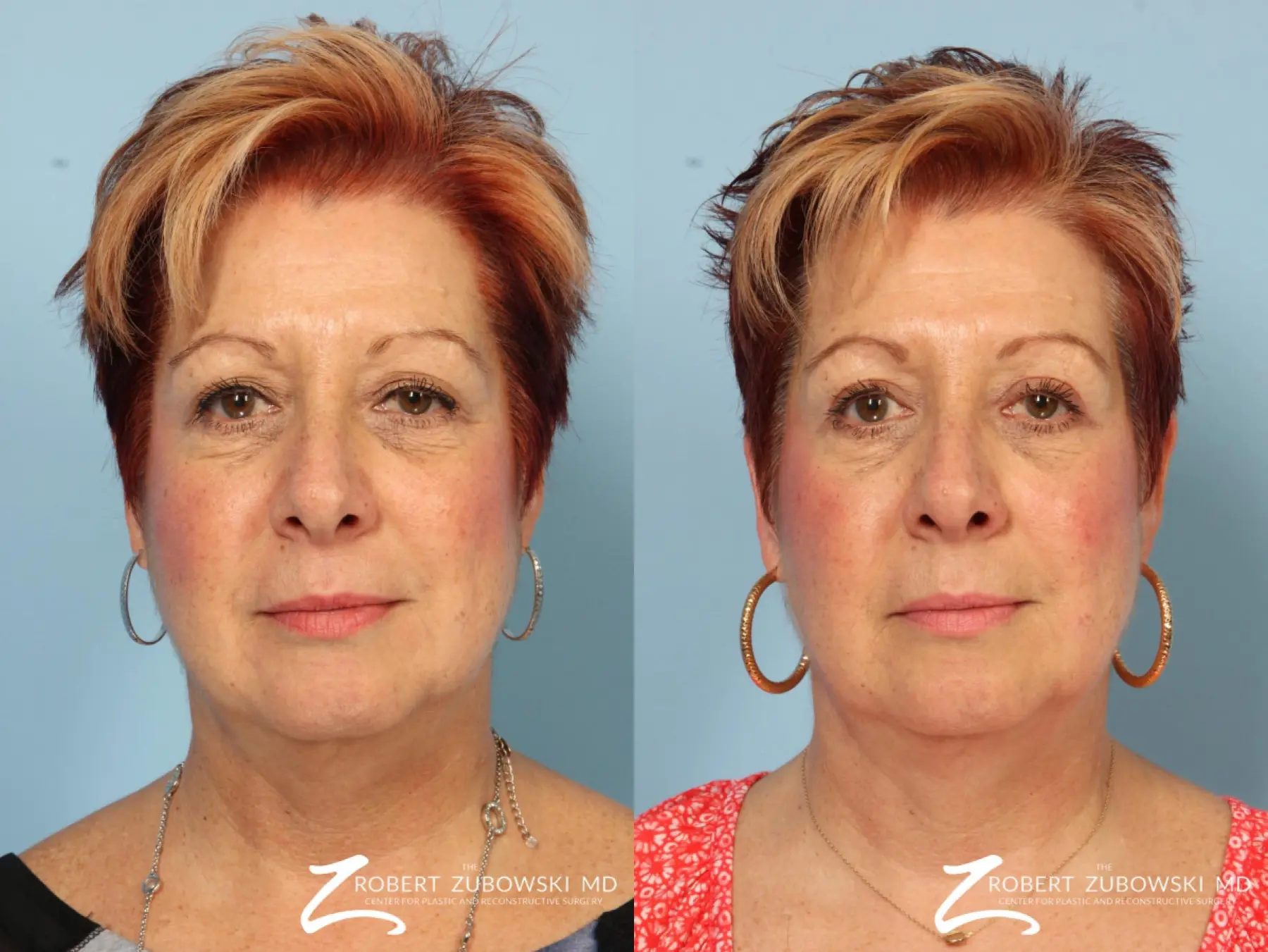 Blepharoplasty: Patient 21 - Before and After 1