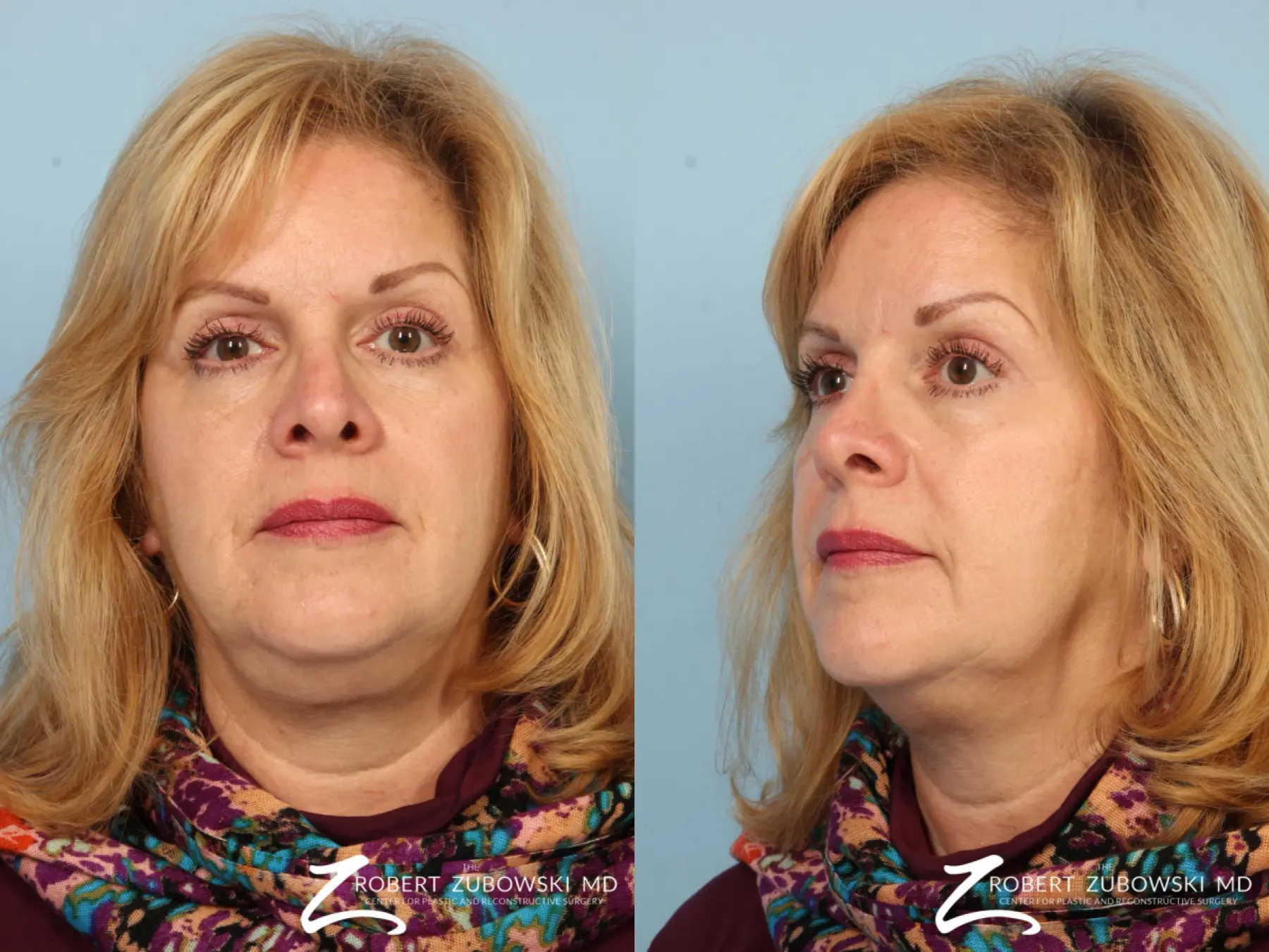 Blepharoplasty: Patient 28 - Before and After 2
