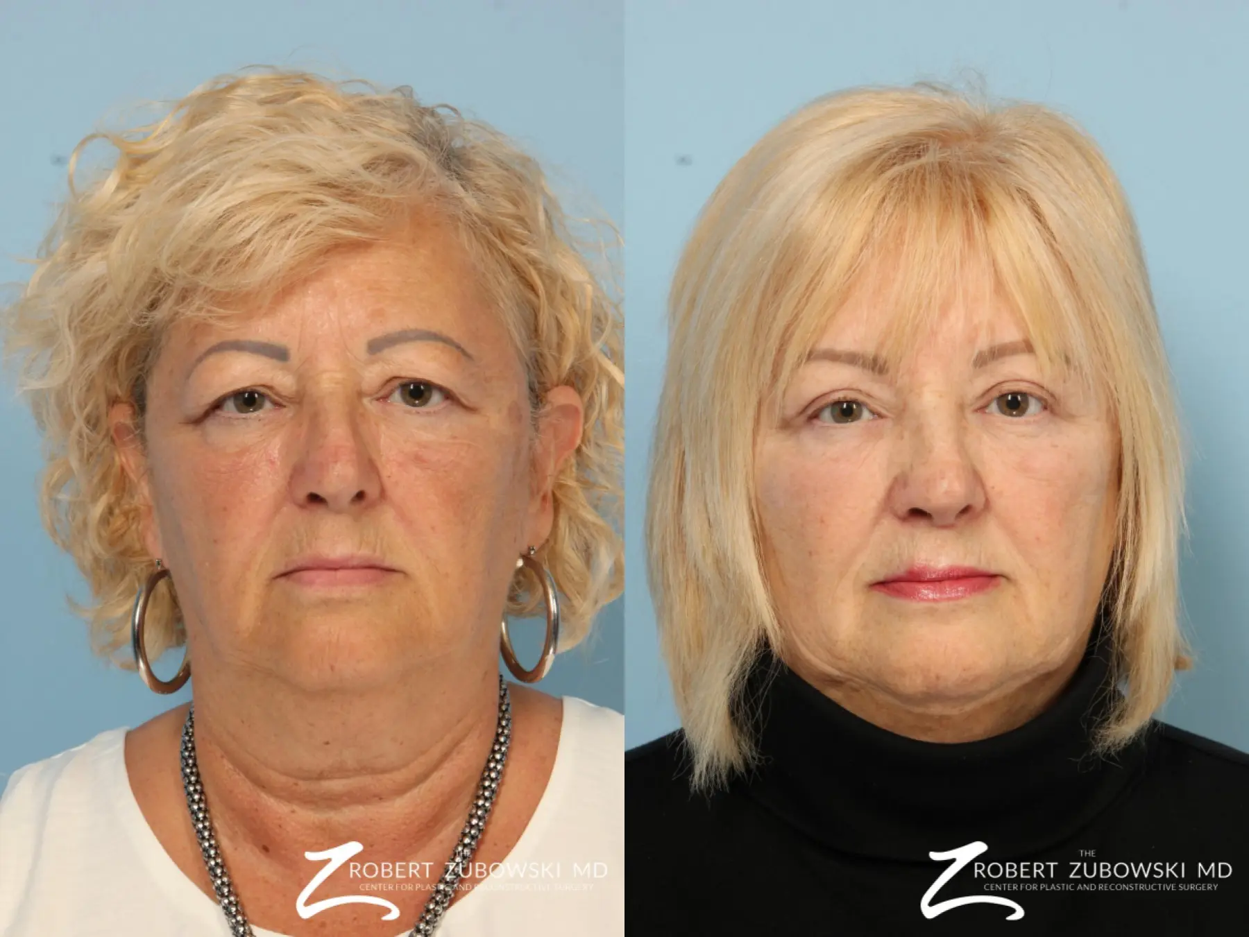Blepharoplasty: Patient 16 - Before and After 1