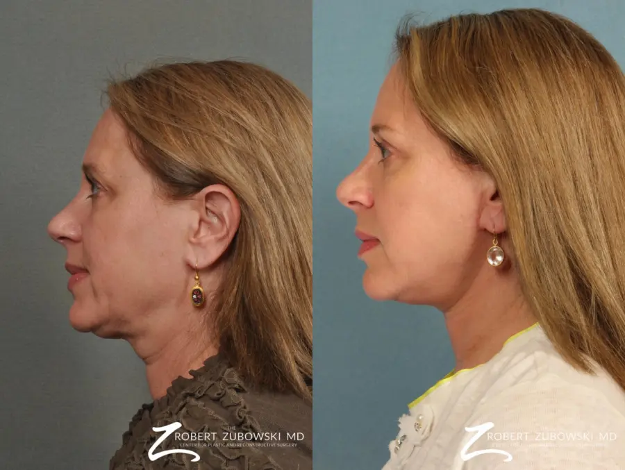 Blepharoplasty: Patient 20 - Before and After 2