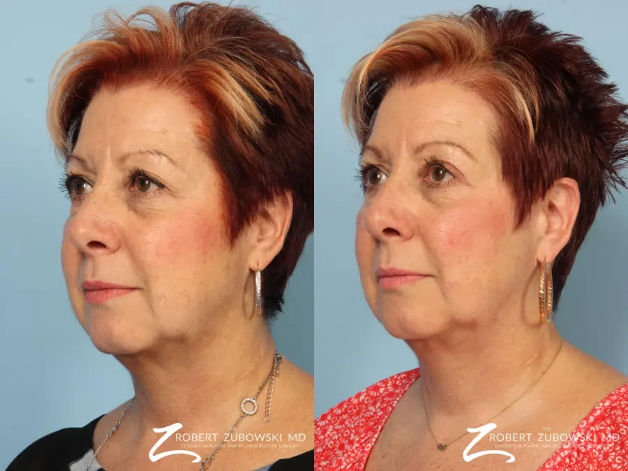 Blepharoplasty: Patient 21 - Before and After 2