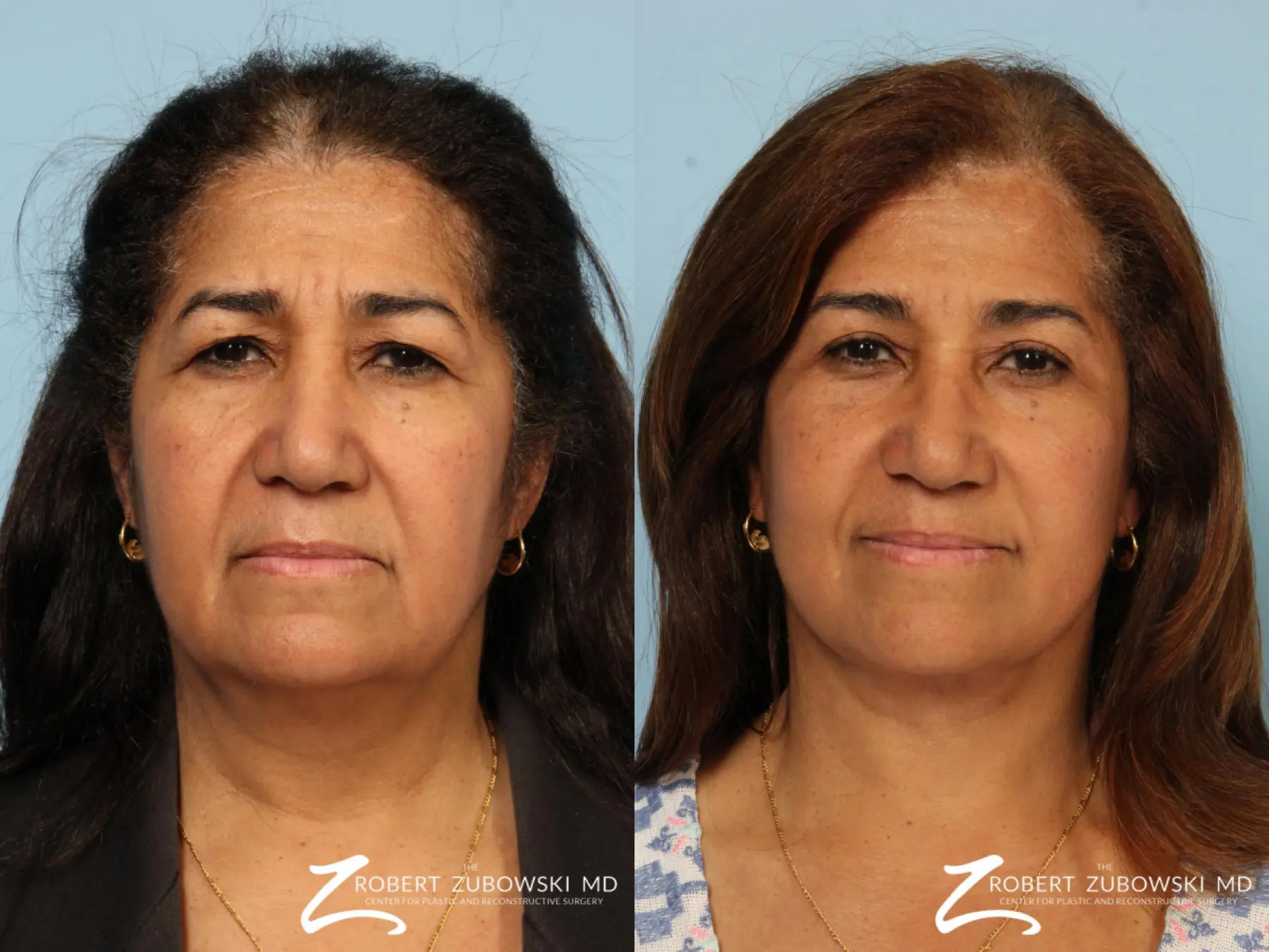 Blepharoplasty: Patient 27 - Before and After 1