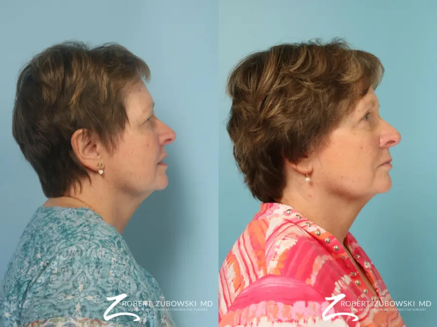 Blepharoplasty: Patient 38 - Before and After 2