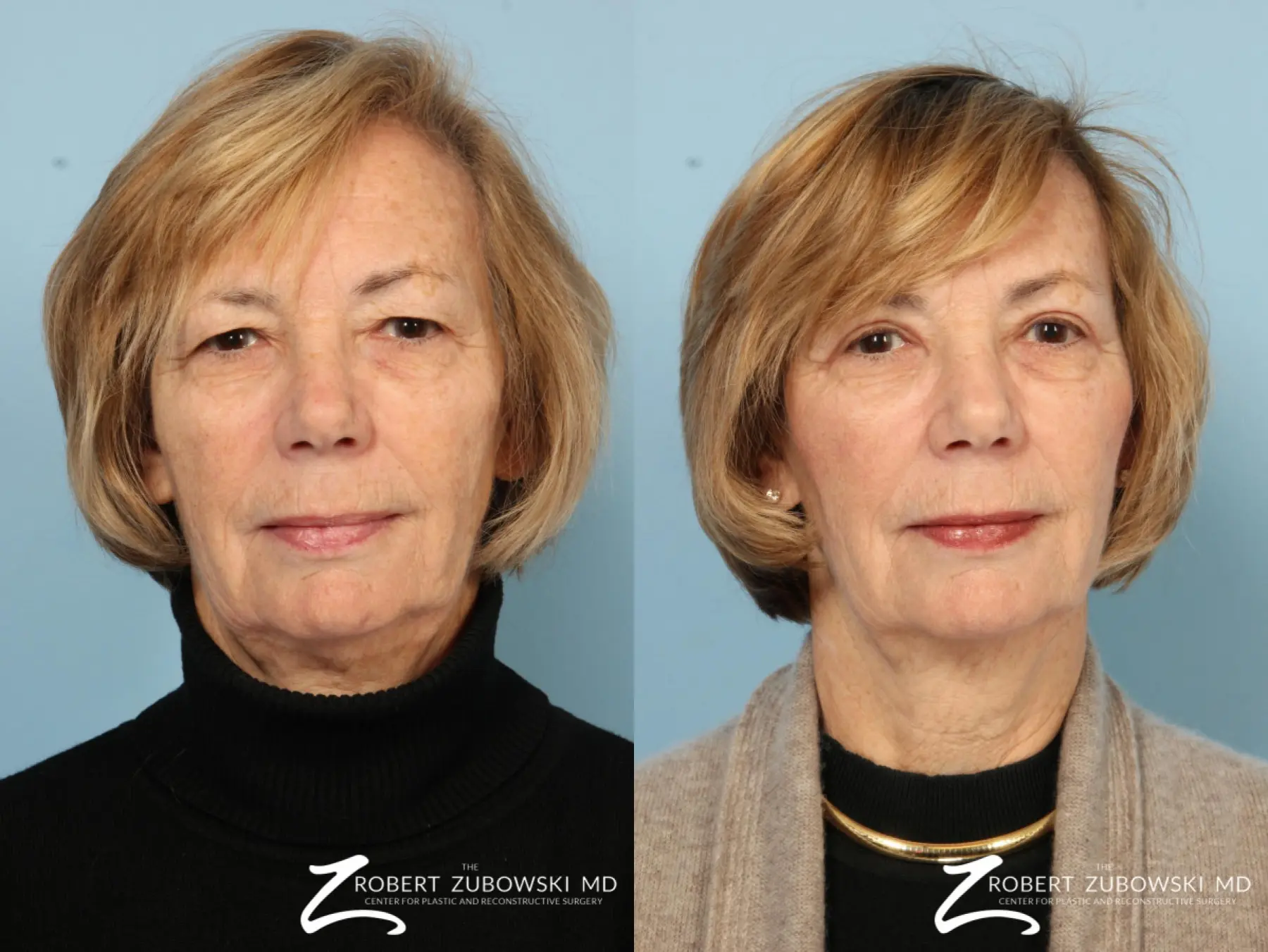Blepharoplasty: Patient 24 - Before and After 1