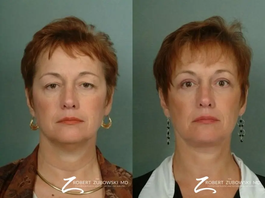 Blepharoplasty: Patient 1 - Before and After  