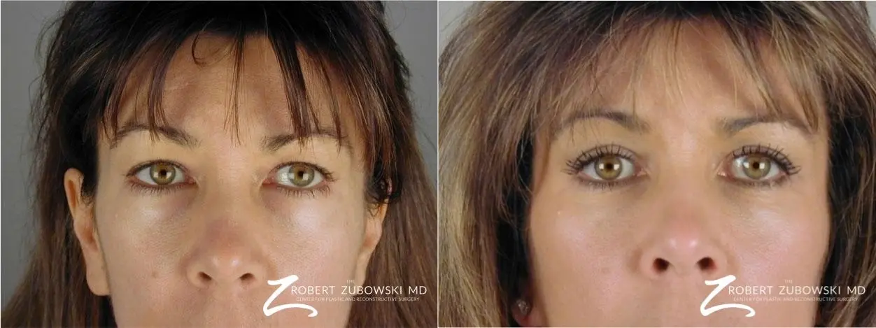 Blepharoplasty: Patient 6 - Before and After  