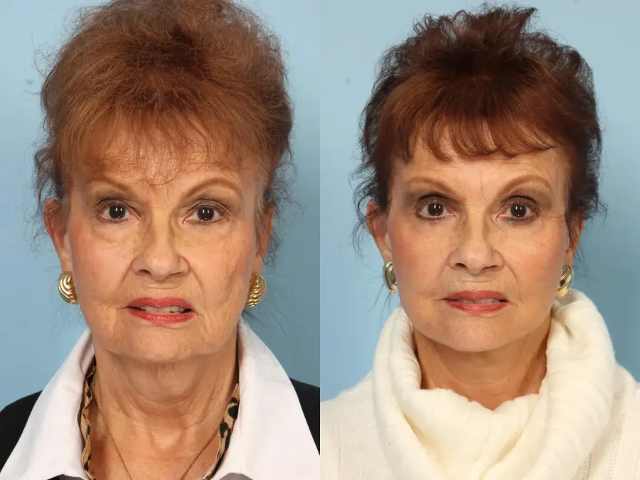 Blepharoplasty: Patient 20 - Before and After 1