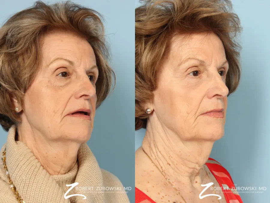 Blepharoplasty: Patient 30 - Before and After 2