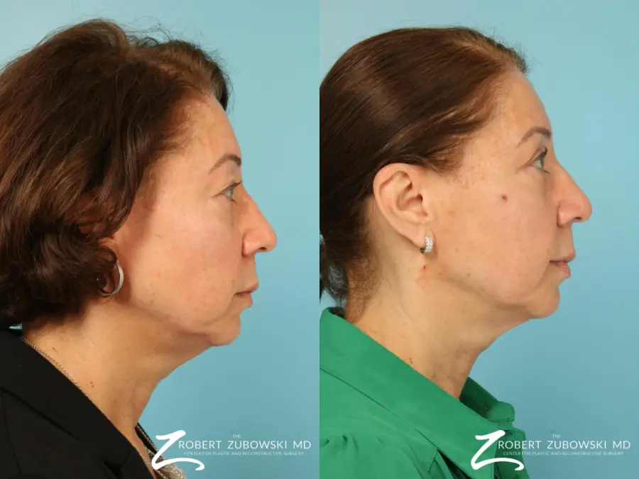 Blepharoplasty: Patient 31 - Before and After 2