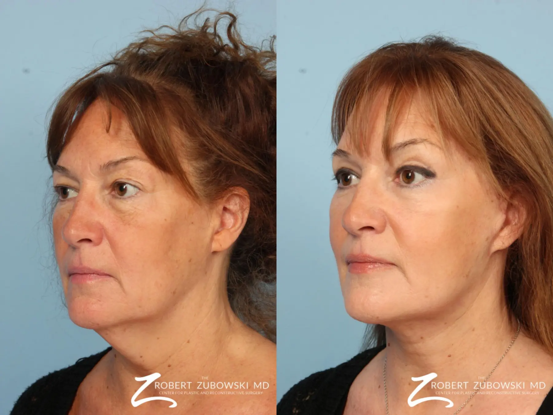 Blepharoplasty: Patient 18 - Before and After 2