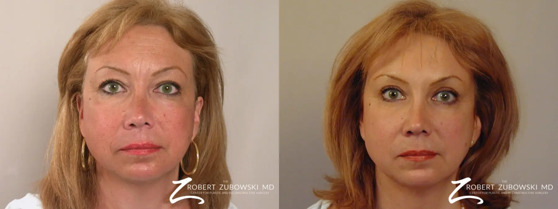 Blepharoplasty: Patient 34 - Before and After 1