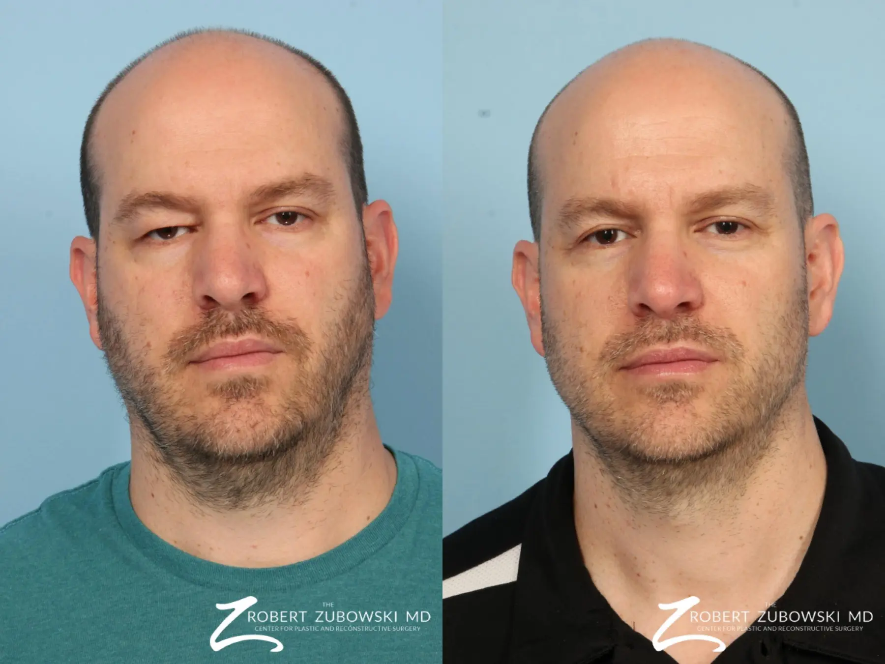 Blepharoplasty For Men: Patient 3 - Before and After 1