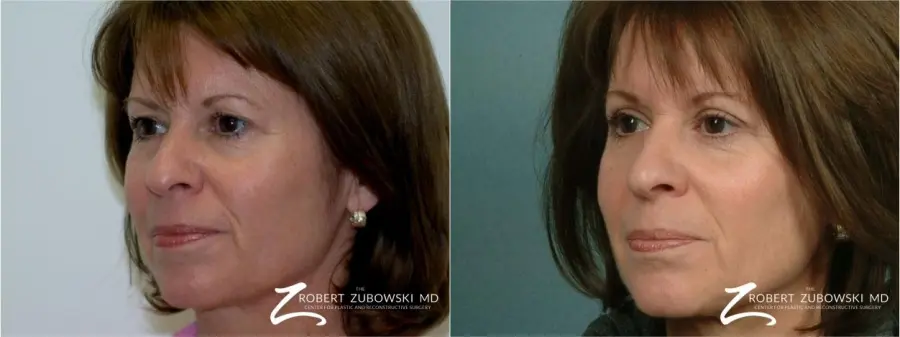 Blepharoplasty: Patient 35 - Before and After 1