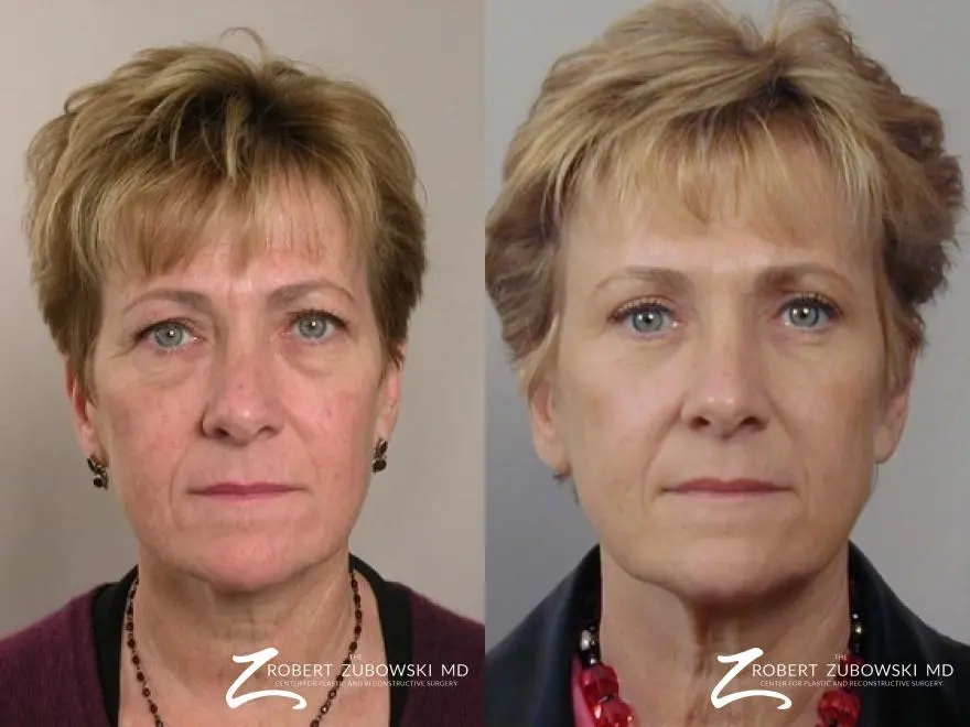 Blepharoplasty: Patient 10 - Before and After  