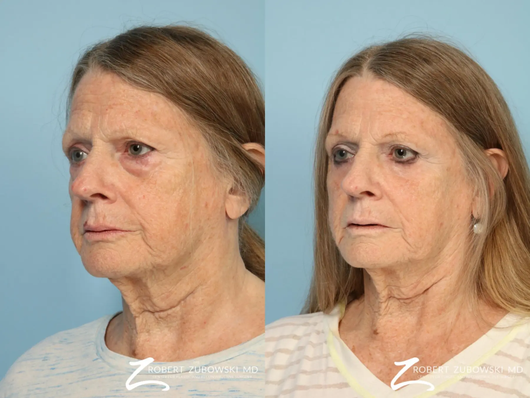 Blepharoplasty: Patient 33 - Before and After 2