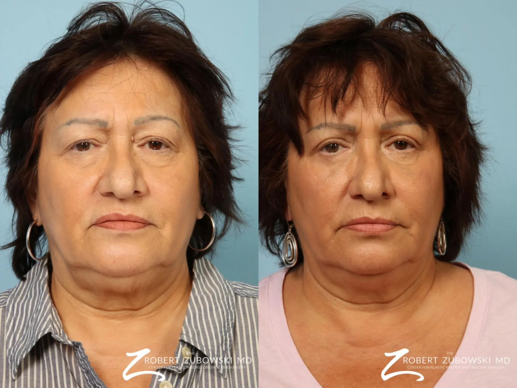 Blepharoplasty: Patient 26 - Before and After 1