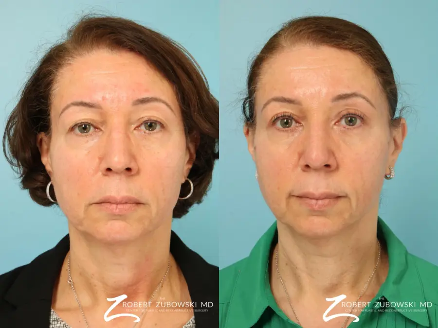 Blepharoplasty: Patient 31 - Before and After 1