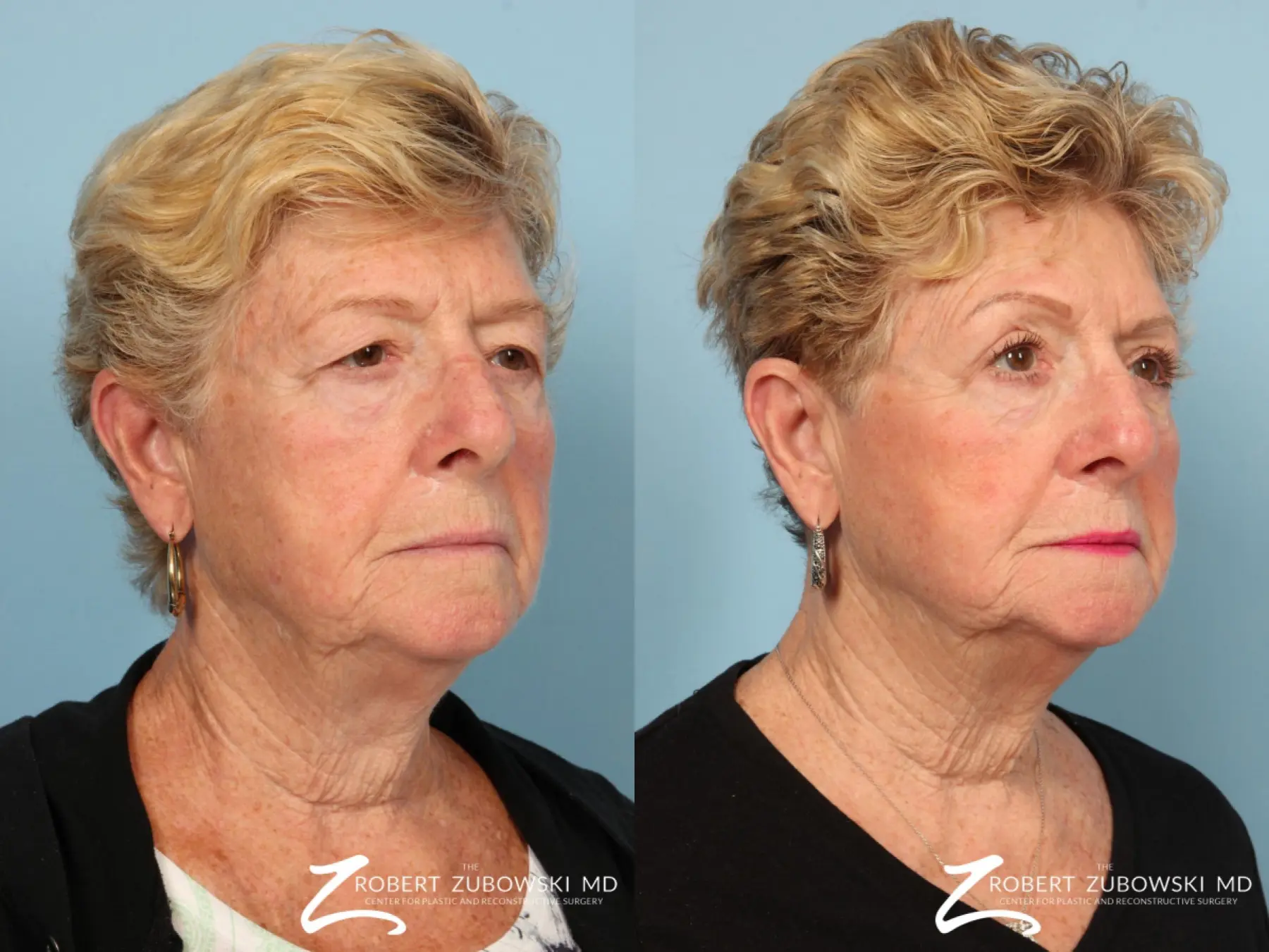 Blepharoplasty: Patient 25 - Before and After 2