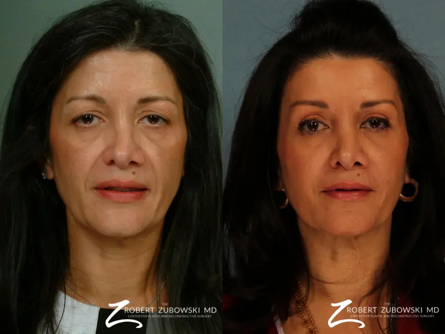 Blepharoplasty: Patient 18 - Before and After 1