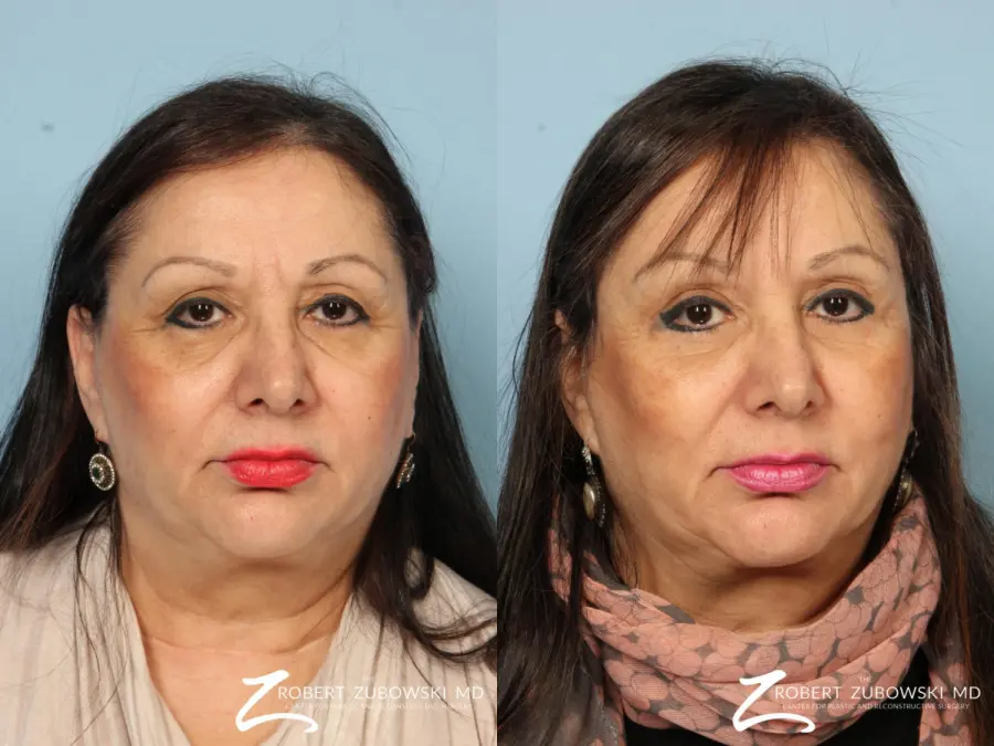 Blepharoplasty: Patient 35 - Before and After 1