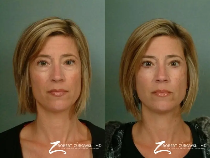 Blepharoplasty: Patient 10 - Before and After  