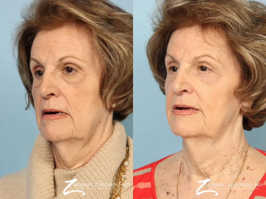 Blepharoplasty: Patient 30 - Before and After 3