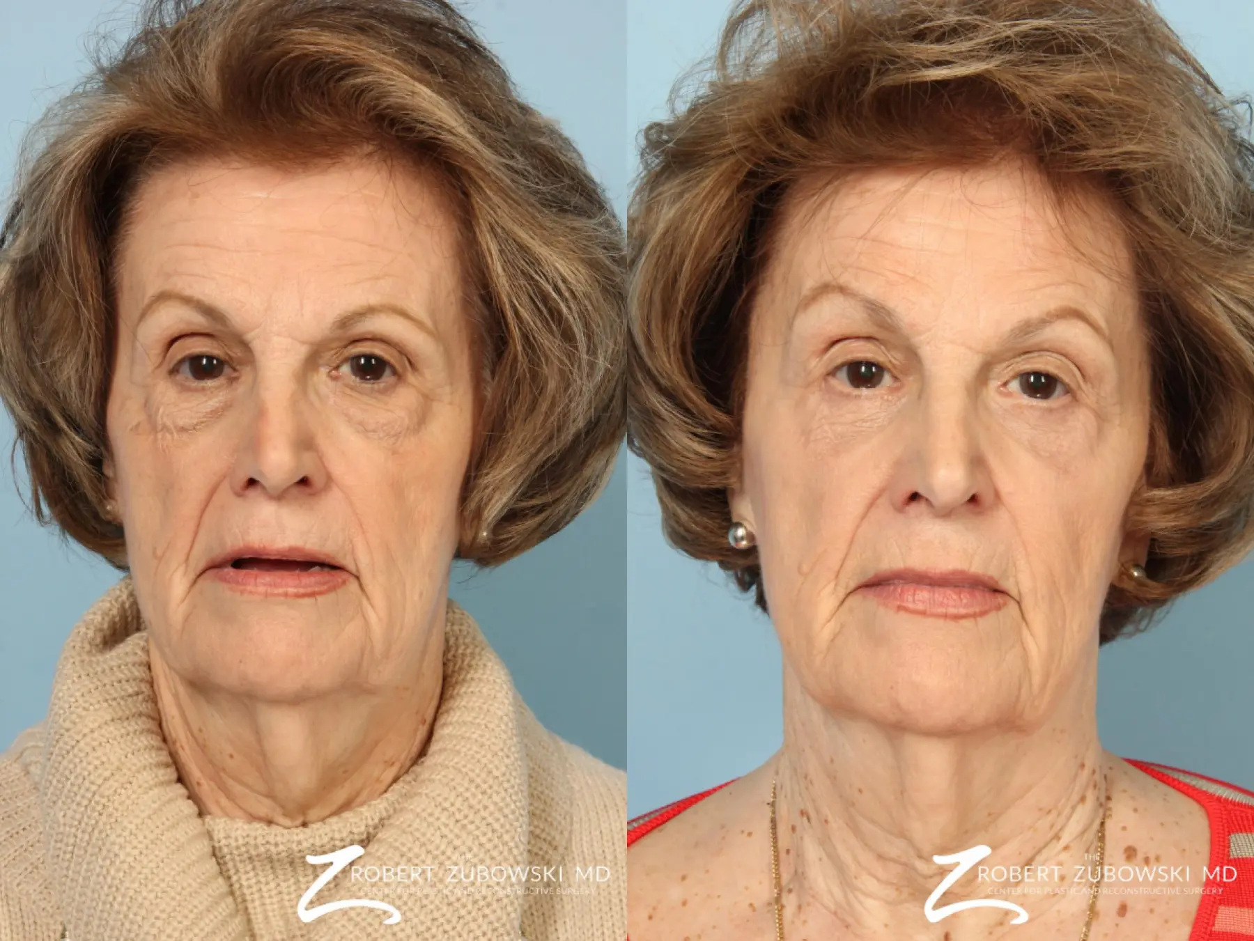 Blepharoplasty: Patient 30 - Before and After 1