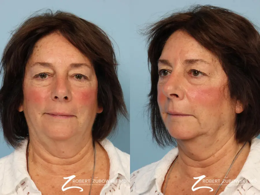 Blepharoplasty: Patient 32 - Before and After 1