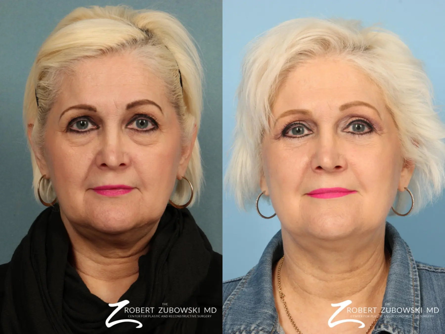 Blepharoplasty: Patient 3 - Before and After  