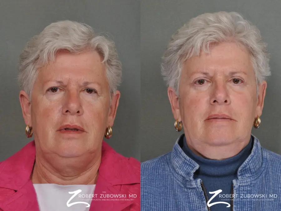 Blepharoplasty: Patient 23 - Before and After 1