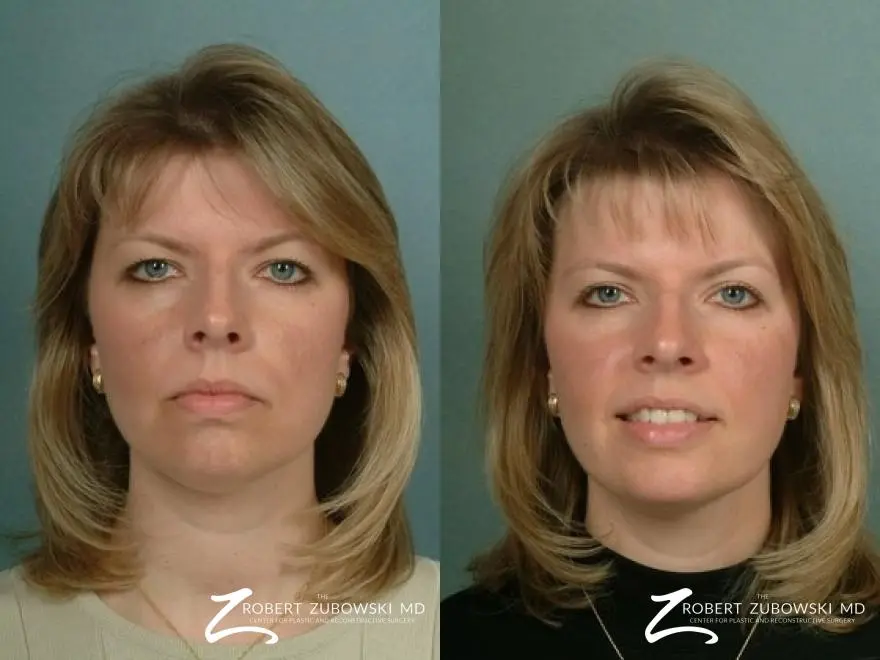 Blepharoplasty: Patient 6 - Before and After 1