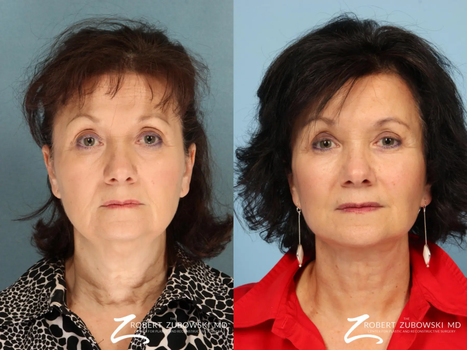 Blepharoplasty: Patient 4 - Before and After  