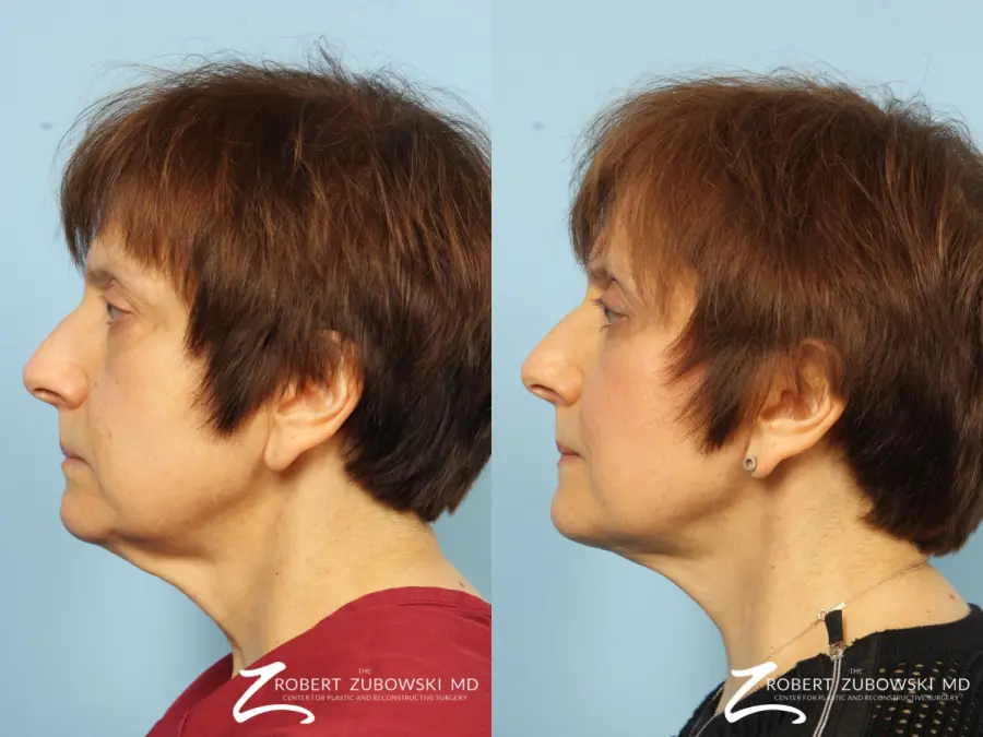 Blepharoplasty: Patient 22 - Before and After 3