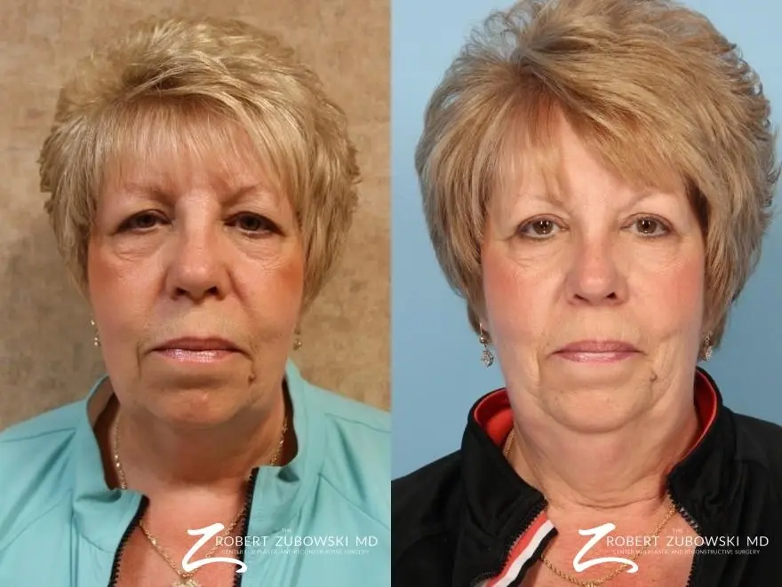 Blepharoplasty: Patient 2 - Before and After  