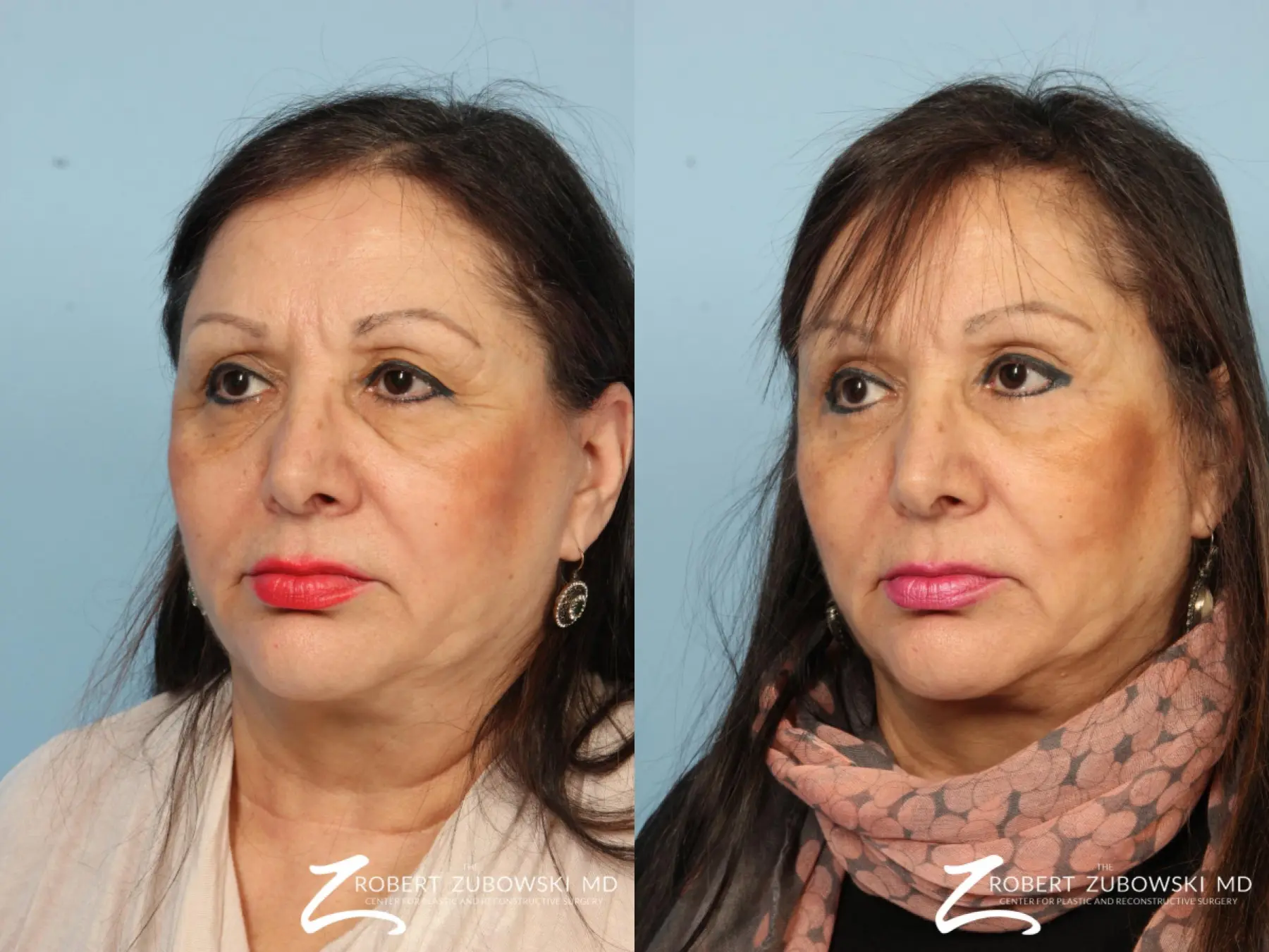 Blepharoplasty: Patient 29 - Before and After 2